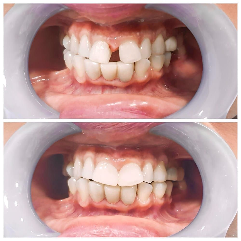 Dental Bonding in Berkeley, CA