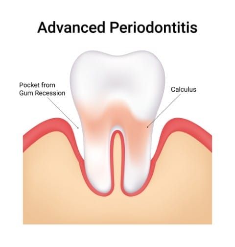 Periodontal Treatment in Berkeley, CA