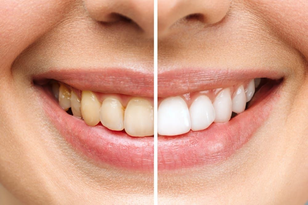 Professional Teeth Whitening in Berkeley, CA