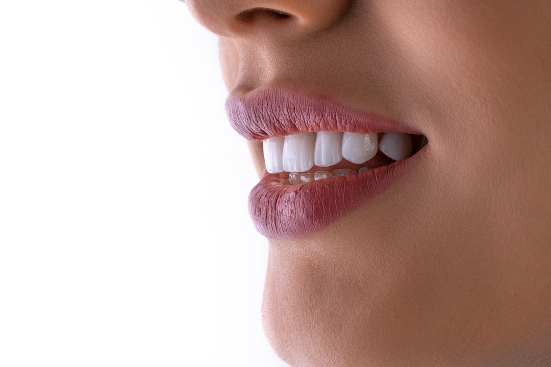 Professional Teeth Whitening in Berkeley: How It Works, What It Costs