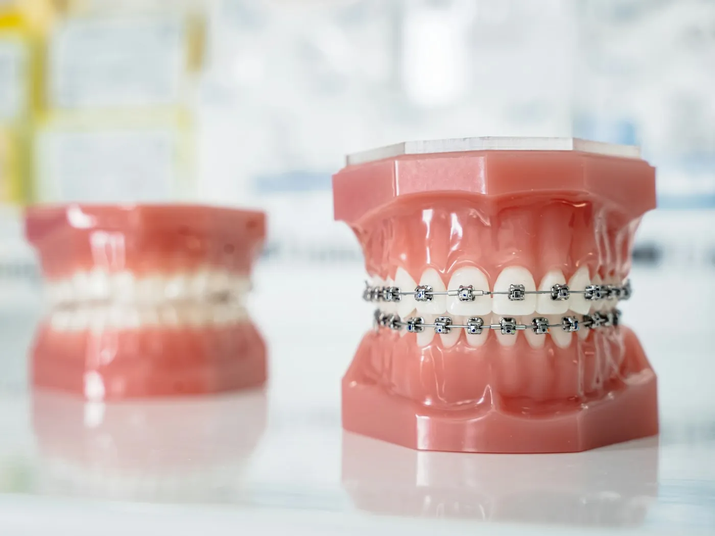 Gold Braces in Berkeley: What They Cost, How Long Treatment Takes, and Who's a Candidate